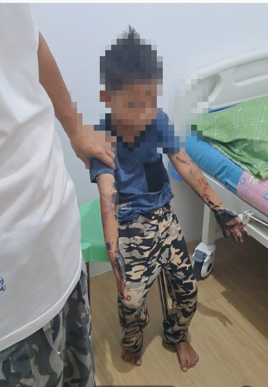 Aspal Cair di Jalan Husni Basri Diduga Picu Kecelakaan, Ibu dan Anak Terluka 2